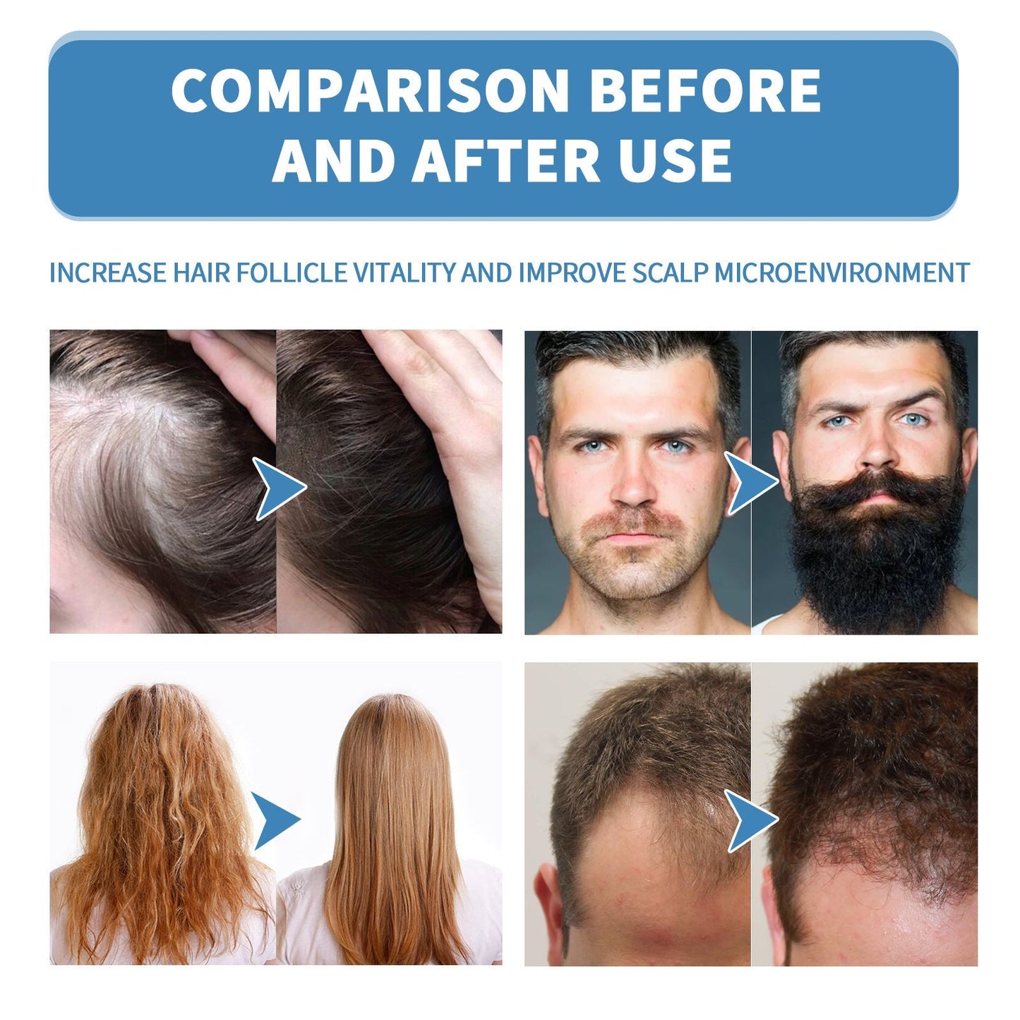 🔥Limited-time 50% off🌿EAST MOON Minoxi Roll-On Hair Treatment